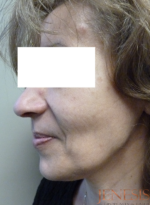 Ultherapy