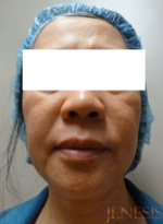 Ultherapy
