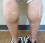 Botox Calf