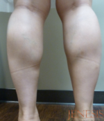 Botox Calf