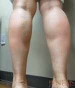 Botox Calf