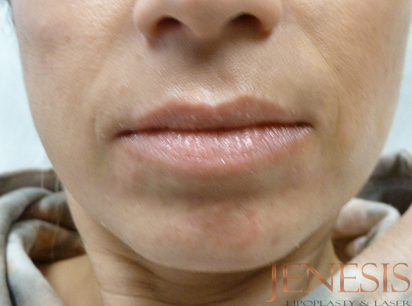 Juvederm