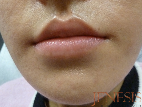 Juvederm