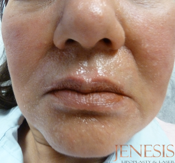 Juvederm