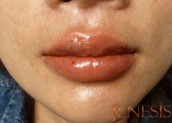 Juvederm