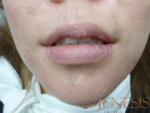 Juvederm
