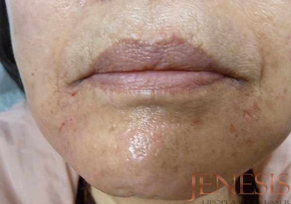 Juvederm