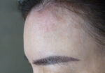 Belotero Forehead