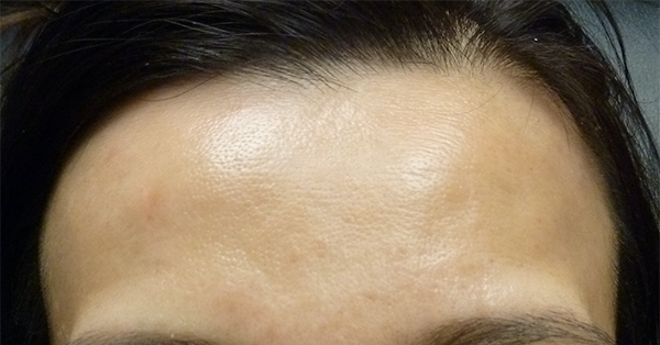 Belotero Forehead