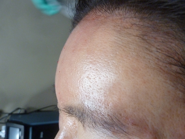 Belotero Forehead