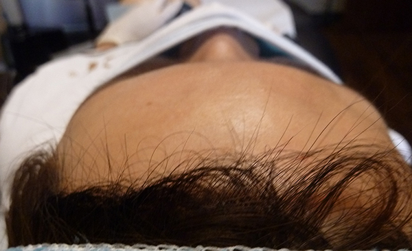 Belotero Forehead