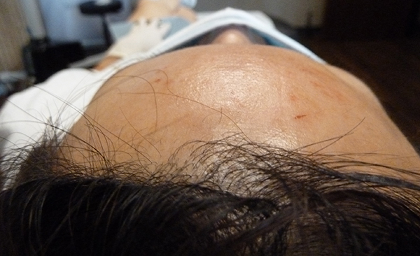 Belotero Forehead