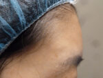 Belotero Forehead