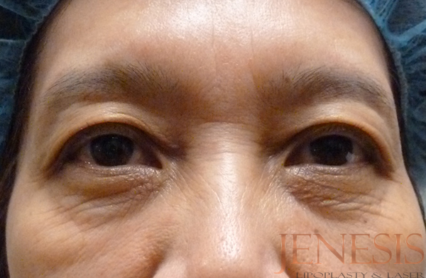 Non-surgical Dark circle removal with Filler