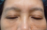 Non-surgical Dark circle removal with Filler