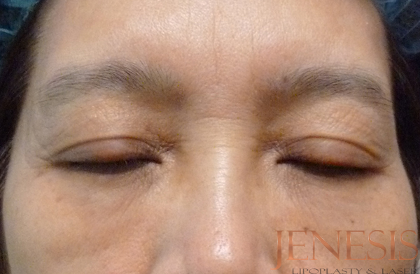 Non-surgical Dark circle removal with Filler