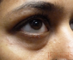 Non-surgical Dark circle removal with Filler