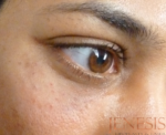 Non-surgical Dark circle removal with Filler