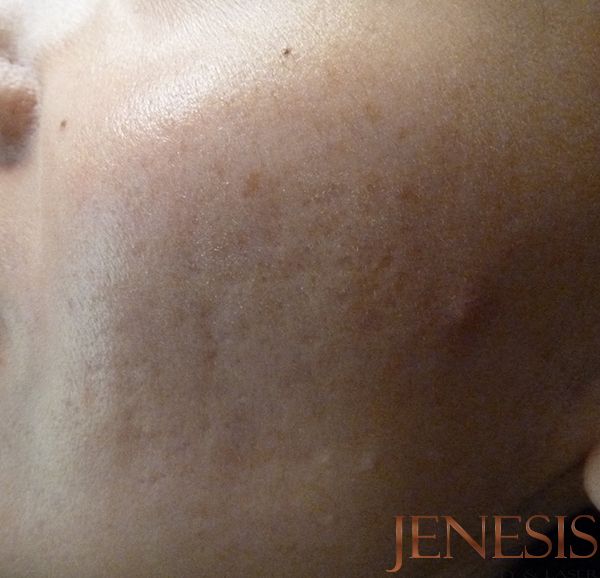 Skin Booster Filler