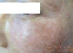 Skin Booster Filler