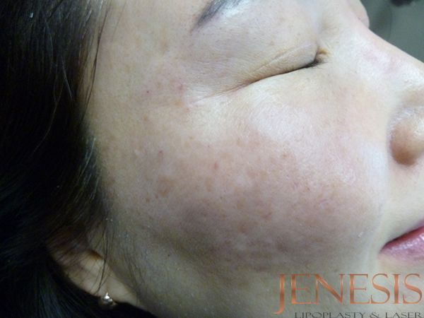 Skin Booster Filler