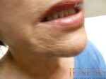 Skin Booster Filler