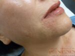 Skin Booster Filler