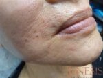 Skin Booster Filler