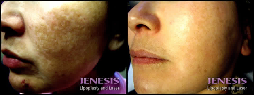 san jose facial rejuvenation In twenties look like teen