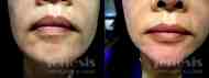 juvederm before after 3