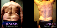 Laser Liposuction Before & After Results