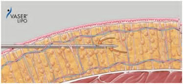 Liposelection