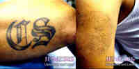 tatoo removal 1 Laser Tattoo Removal