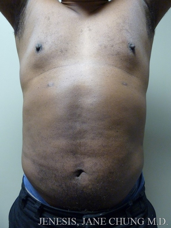 Vaser Liposuction Before and After Results