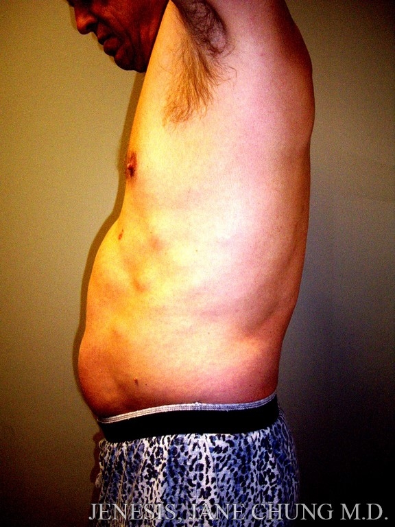 San Jose Vaser Hi Def Liposelection Before and After Photos - San