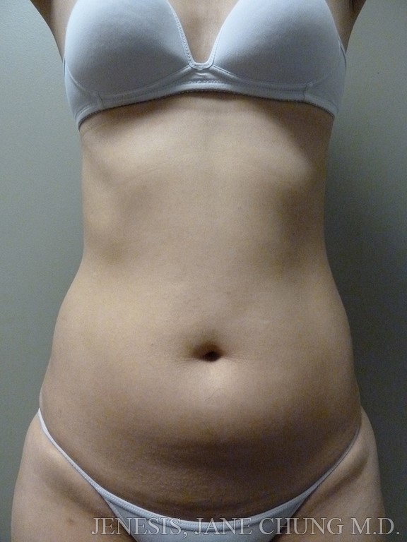 3D Micro Lipo Before and After Results