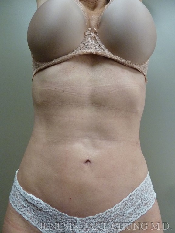 Revision Liposuction Before and After Results