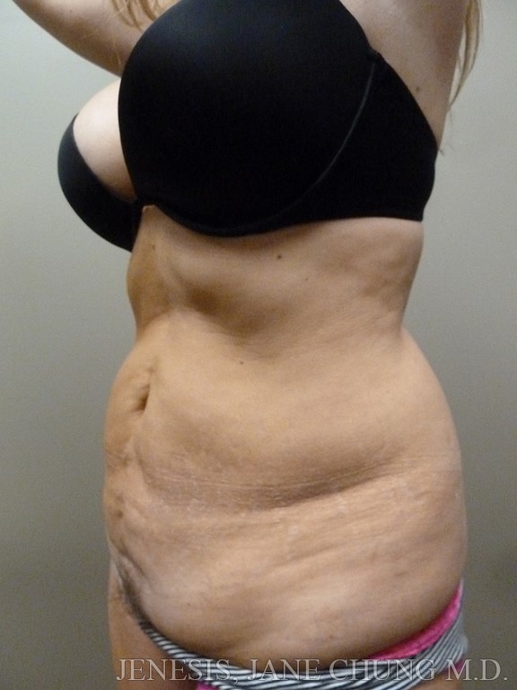 San Jose Revision Liposuction Before and After Photos - San Francisco