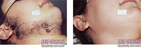 Gentlelase Hair Removal