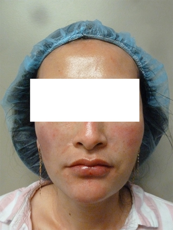 Botox Jaw Slimming Before and After Results